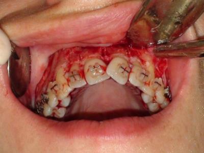 Des corticotomies sont réalisées dans le secteur incisivo-canin mandibulaire pour faciliter l’ingression et l’alignement des incisives, et dans le secteur antérieur et latéral droit maxillaire pour distaler la canine et le groupe prémolo-molaire, et recentrer les incisives (b).