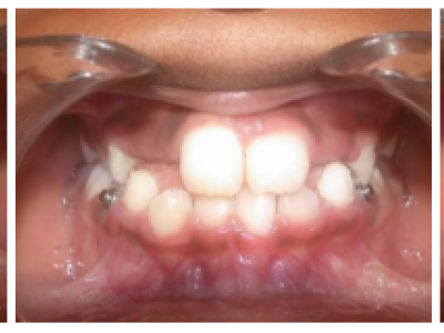 Fig. 5 Photographies intraorales à l’arrêt de la 1ère phase de traitement orthopédique