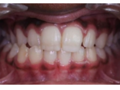 Fig.6 Photographies intraorales avant la reprise du multi-attaches