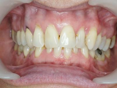 Figure 6 : Patiente adulte présentant un encombrement incisivo-canin mandibulaire sévère avec une supraclusie quasi complète (a) 