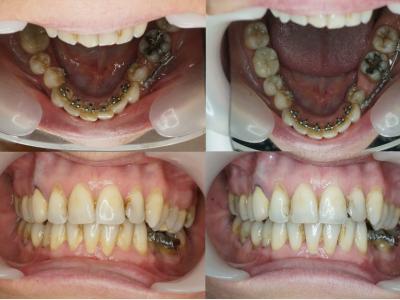 Des corticotomies sont réalisées de 34 à 43 avec apport d’allogreffe vestibulaire et les dents sont repositionnées avec un appareil lingual 2D antérieur et un sectoriel latéral réouvrant l’espace de 35 (d). 
