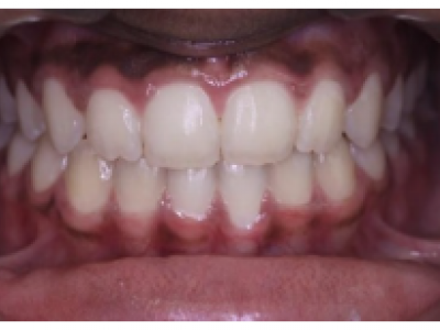 Fig. 7 Photographies intraorales après le multi-attaches