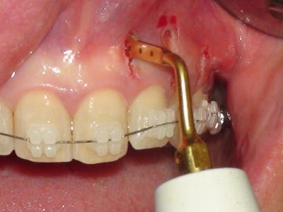 Figure 7 : Corticotomies mini-invasives au piezotome (a)