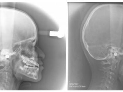 Fig. 8 Téléradiographies de profil après le passage de l’occlusion et 2 ans après