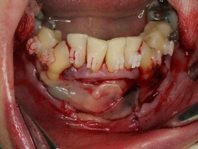 mise en place de la membrane PRF par-dessus (d)