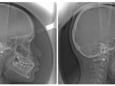 Fig. 9 Téléradiographies de profil avant et après le multi-attaches