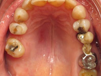 Cas 2 - Vue occlusale initiale