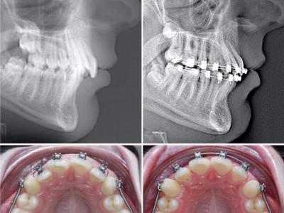 Evolution à 8 semaines sur téléradiographie de profil et vue occlusale