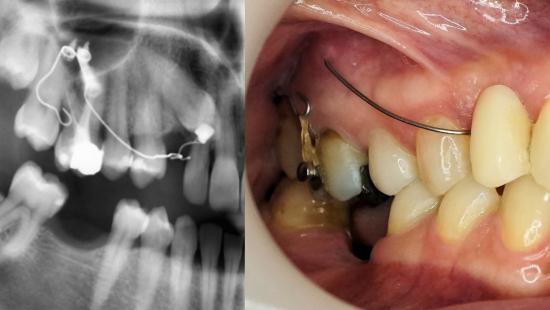 Minivis d'ancrage orthodontique DX-OMIA System