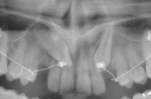 Double traction de canines incluses avec dispositif CT8