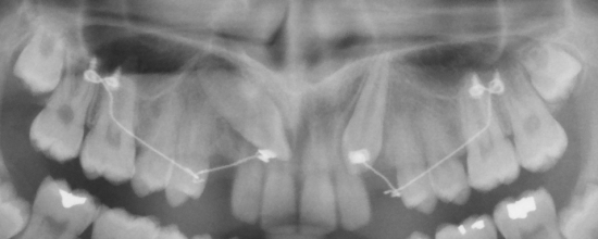 Double traction de canines incluses avec dispositif CT8