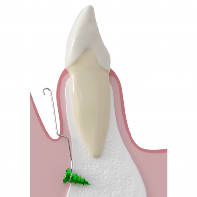 Kieferorthopädische Knochenverankerung – CT8® System