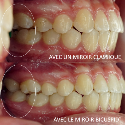 Miroir Dentaire existent Anti-Austin pour Photographie Buccale, Réflecteur  Orthodontique, Buccal, Occlusal, Lingual, Fournitures de Dentiste