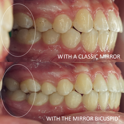 Dental photographic mirror - Lateral view