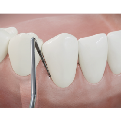 Sondage parodontal 3D