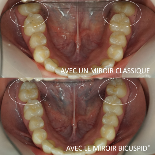 Miroir dentaire photographique - Vue occlusale