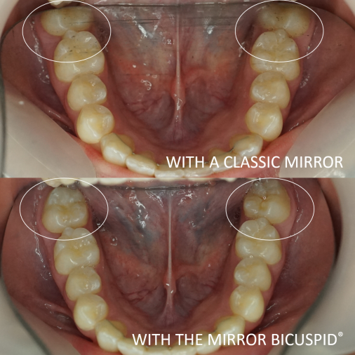 Dental photographic mirror - Occlusal view