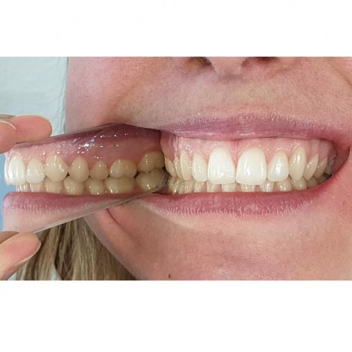 Orthodontie Intra-orale Photographie Réflecteur Dentaire Miroir