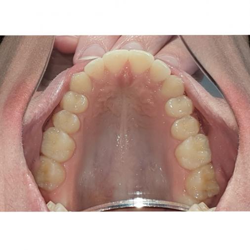 Occlusal sup